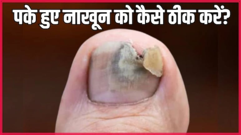 बार-बार पक जाता है पैर का नाखून? डॉक्टर से जान लें कैसे हमेशा के लिए दूर होगी दिक्कत