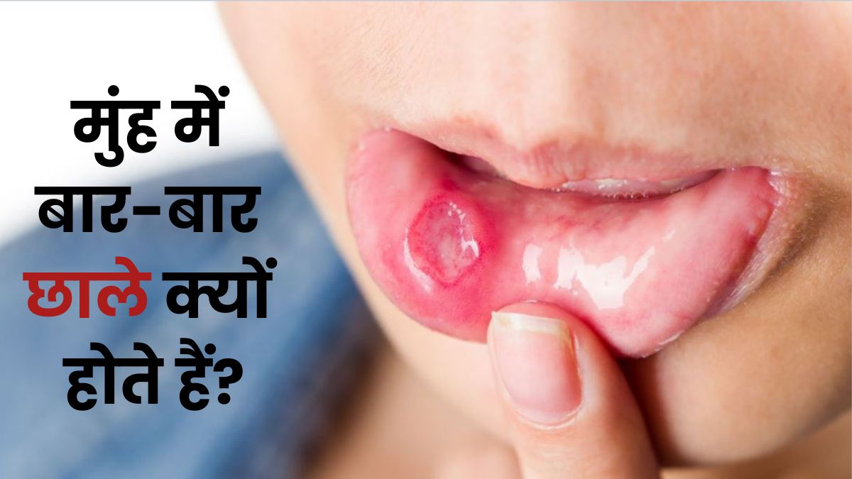 किस विटामिन की कमी से होते हैं छाले? ये खाएंगे तो सुबह तक हो जाएंगे छूमंतर