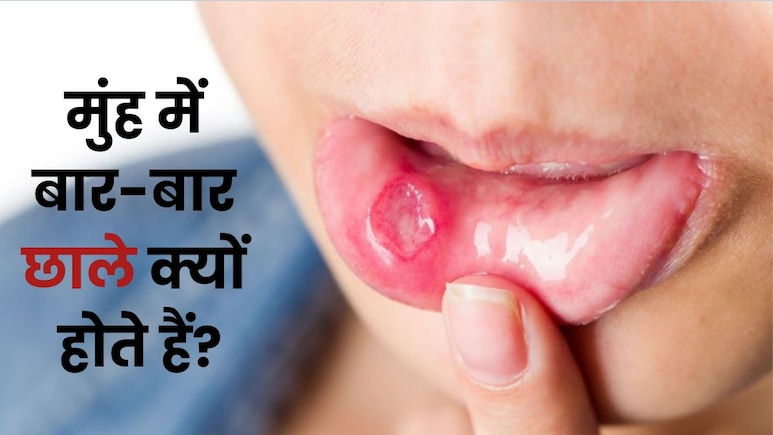 किस विटामिन की कमी से होते हैं छाले? ये खाएंगे तो सुबह तक हो जाएंगे छूमंतर किस विटामिन की कमी से होते हैं छाले? ये खाएंगे तो सुबह तक हो जाएंगे छूमंतर