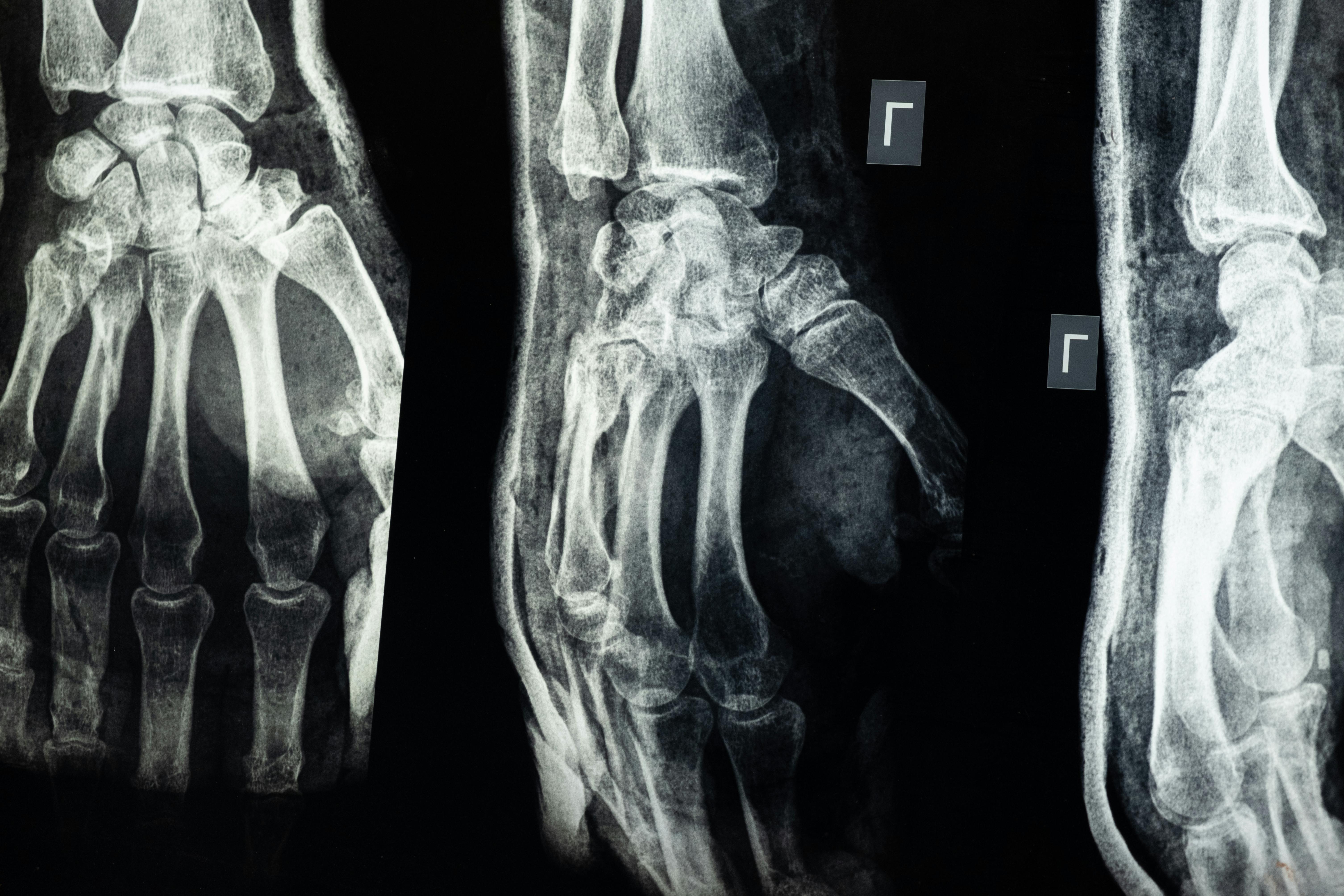 Chinese Scientists Create 'Bone Glue' That Repairs Fractures In Just 3 Minutes