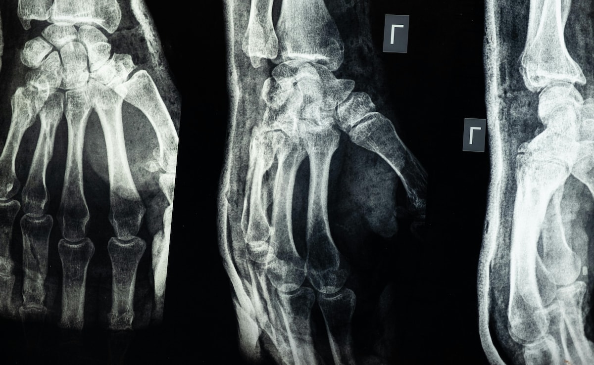 Chinese Scientists Create 'Bone Glue' That Repairs Fractures In Just 3 Minutes