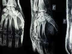 Chinese Scientists Create 'Bone Glue' That Repairs Fractures In Just 3 Minutes