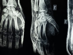 Chinese Scientists Create &#039;Bone Glue&#039; That Repairs Fractures In Just 3 Minutes