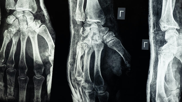 Chinese Scientists Create 'Bone Glue' That Repairs Fractures In Just 3 Minutes