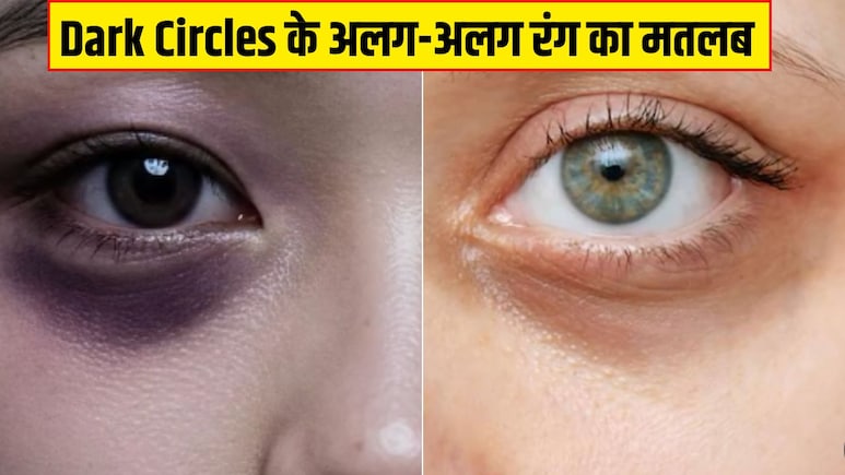 आंखों के नीचे नीले या ब्राउन घेरे क्यों हो जाते हैं? न्यूट्रिशनिस्ट ने बताया Dark Circles के अलग-अलग रंग का मतलब