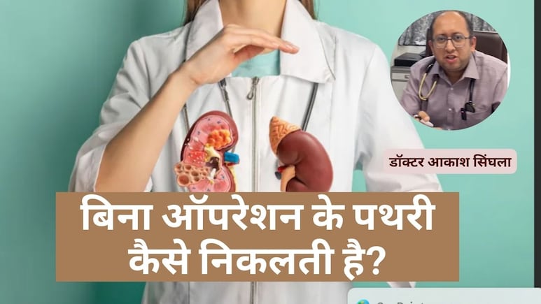 कब कराना चाहिए पथरी का ऑपरेशन, बिना ऑपरेशन के पथरी कैसे निकलती है?
