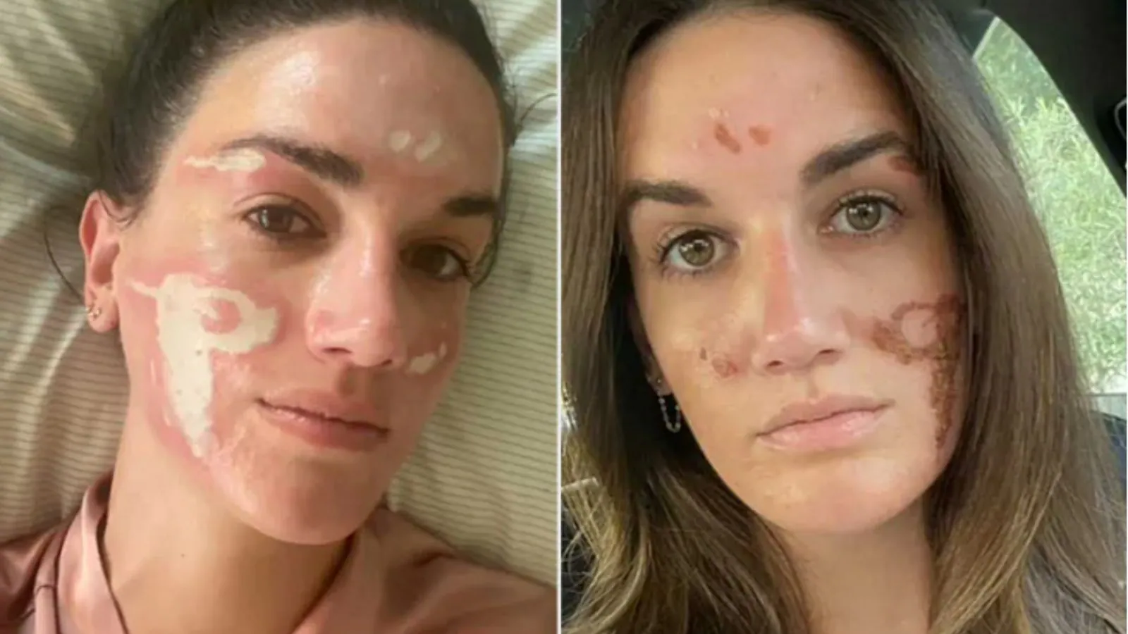 Priyanka Chopra's Facialist Under Fire After Woman Says Chemical Peel Burned Her Face