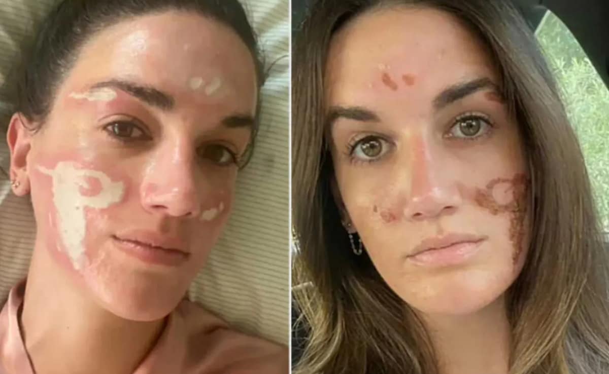 Priyanka's Facialist Under Fire After Woman Says Chemical Peel Burned Her Face