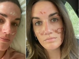 Priyanka Chopra's Facialist Under Fire After Woman Says Chemical Peel Burned Her Face Priyanka Chopra's Facialist Under Fire After Woman Says Chemical Peel Burned Her Face
