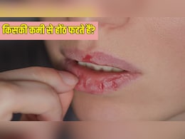 किस विटामिन की कमी से होंठ फटते हैं? किस विटामिन की कमी से होंठ फटते हैं?