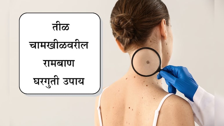 Beauty Tips: चेहऱ्यावरील तीळ-चामखीळमुळे हैराण आहात? करा हे घरगुती उपाय, चेहऱ्यावरही येईल तेज