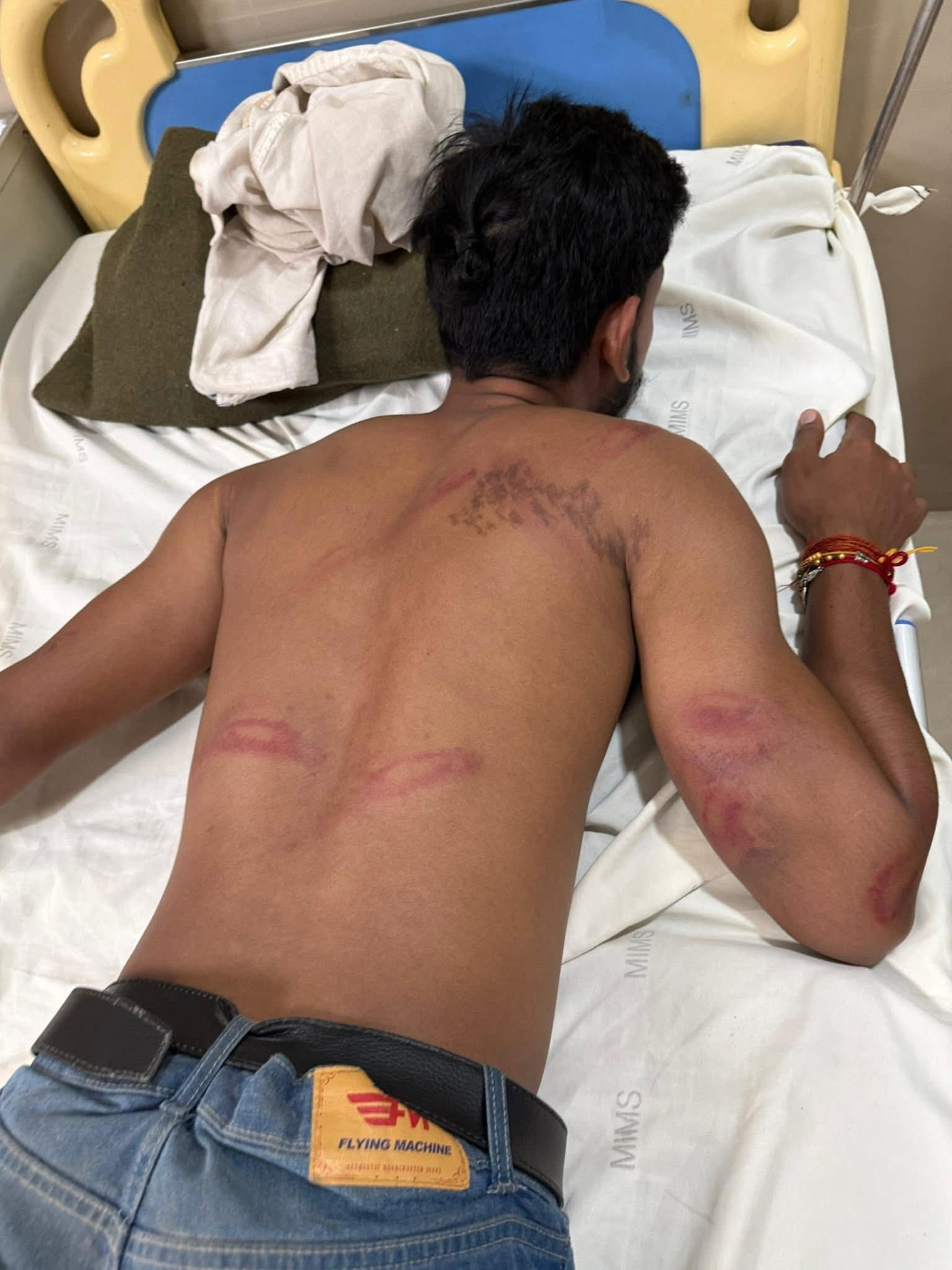 लाठीचार्ज में घायल हुए छात्र का इलाज हॉस्पिटल में चल रहा है. लाठीचार्ज में घायल हुए छात्र का इलाज हॉस्पिटल में चल रहा है.