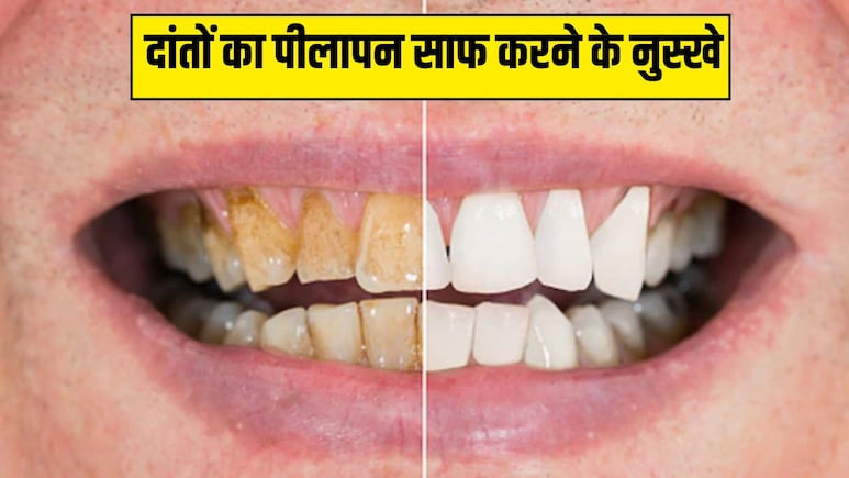 पीले दांतों को सफेद करने के 5 असरदार नुस्खे, कुछ ही दिनों में दिखने लगेगा असर