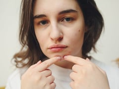 Dermatologist Debunks The Top Five Acne Myths: What You Really Need To Know