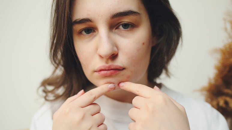 Dermatologist Debunks The Top Five Acne Myths: What You Really Need To Know Dermatologist Debunks The Top Five Acne Myths: What You Really Need To Know