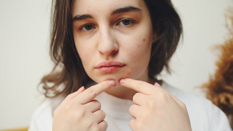 Hormonal Breakouts? Avoid These 10 Skincare Mistakes