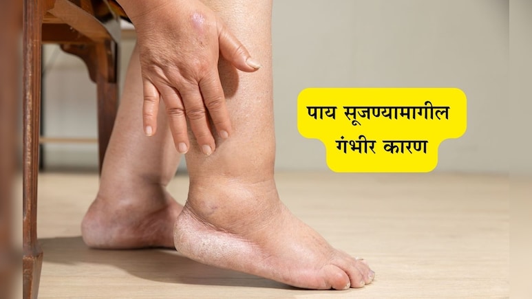 Swollen Legs and Ankles Problems: पायांना सूज येतेय? शरीरामध्ये निर्माण झालीय या महत्त्वपूर्ण गोष्टीची कमतरता Swollen Legs and Ankles Problems: पायांना सूज येतेय? शरीरामध्ये निर्माण झालीय या महत्त्वपूर्ण गोष्टीची कमतरता