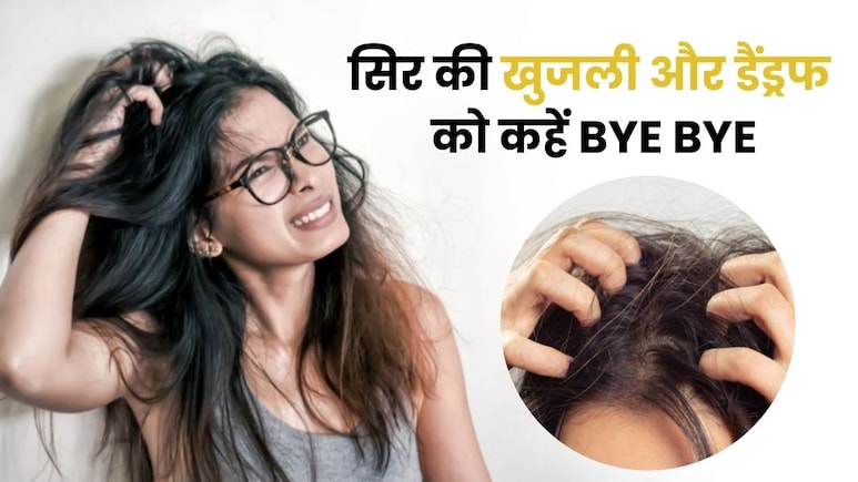 सिर की खुजली और डैंड्रफ के चक्कर में हो रही हैं लोगों के सामने बेइज्जती, करें ये काम...तुरंत मिलेगा आराम