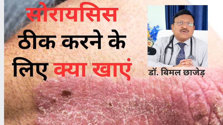 डॉक्टर ने बताया Psoriasis का इलाज, बार-बार खुजलाने से मिलेगा आराम...