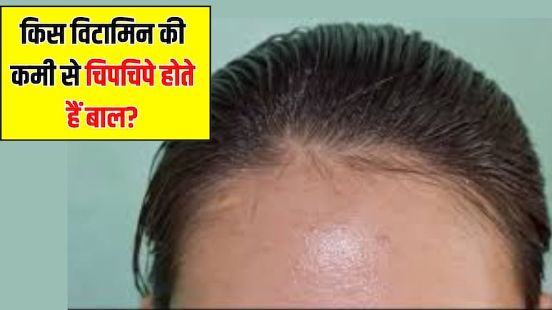 इस विटामिन की कमी से चिपचिपे हो जाते हैं बाल, न्यूट्रिशनिस्ट ने बताया बार-बार धोने पर भी साफ नहीं होता तेल