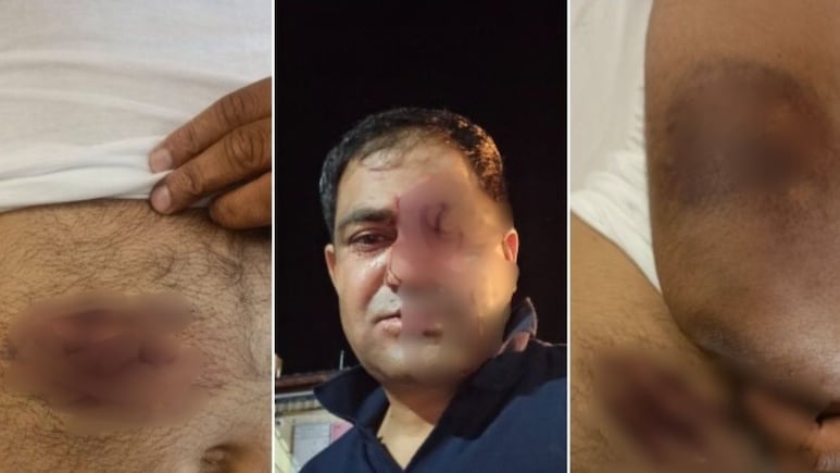 जोधपुर: पुलिस टीम पर कुल्हाड़ी और डंडों से जानलेवा हमला, बिना वर्दी-बिना सूचना पहुंची थी सीकर पुलिस