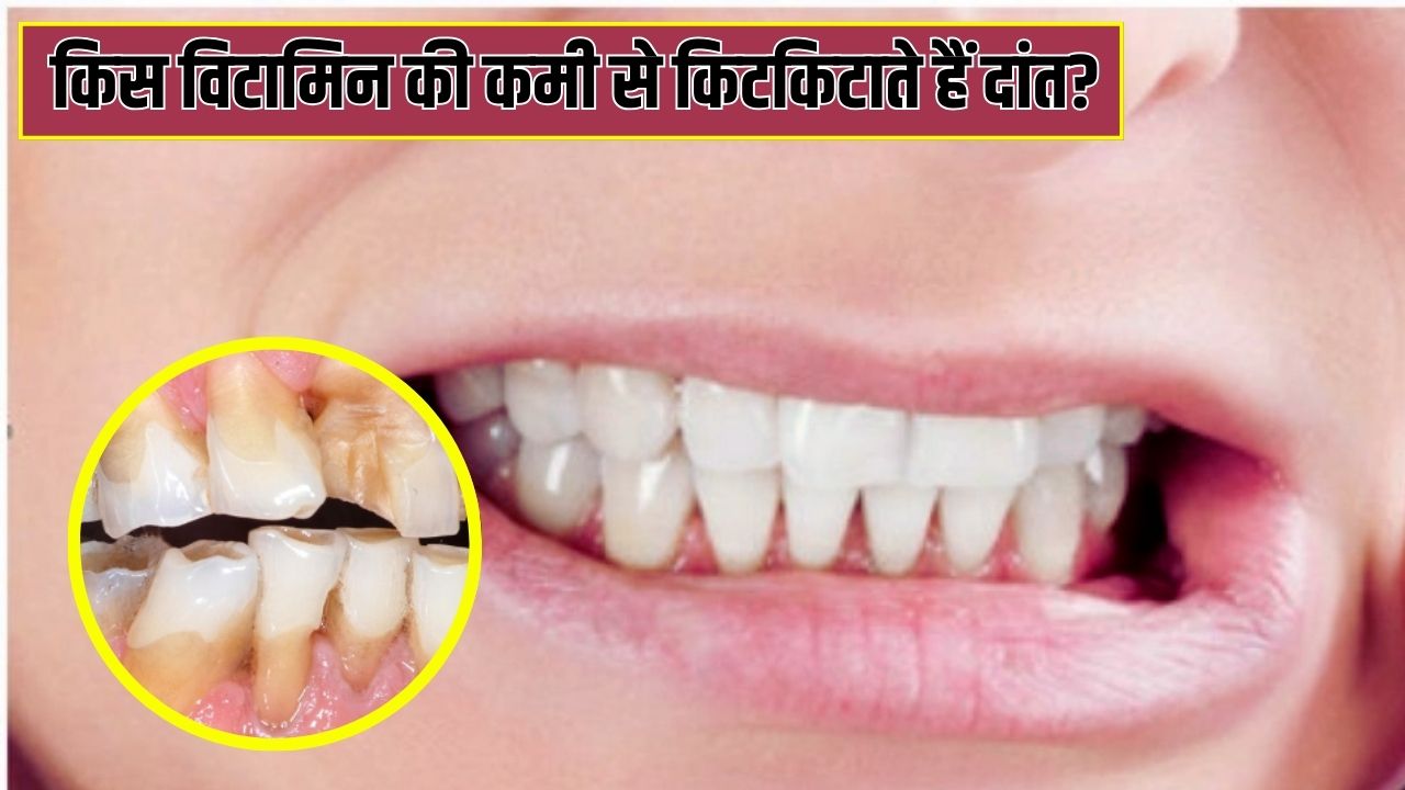 किस विटामिन की कमी से दांत पीसने लगते हैं?