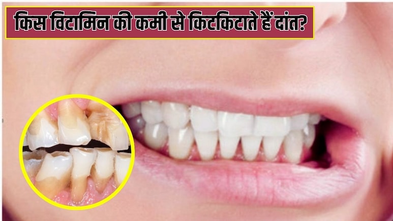किस विटामिन की कमी से दांत पीसने लगते हैं?
