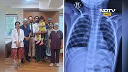 Medical News: साडेतीन वर्षांच्या मुलाच्या फुफ्फुसातून एलईडी बल्ब काढला, डॉक्टरांना कसं शक्य झालं?