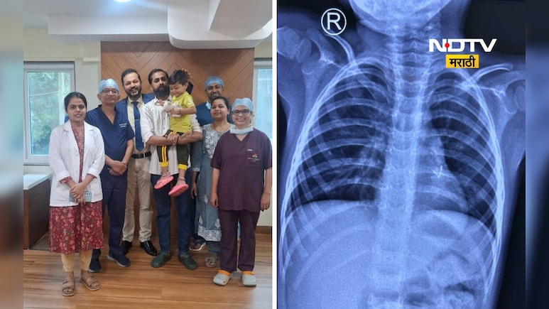 Medical News: साडेतीन वर्षांच्या मुलाच्या फुफ्फुसातून एलईडी बल्ब काढला, डॉक्टरांना कसं शक्य झालं?
