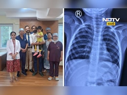 Medical News: साडेतीन वर्षांच्या मुलाच्या फुफ्फुसातून एलईडी बल्ब काढला, डॉक्टरांना कसं शक्य झालं? Medical News: साडेतीन वर्षांच्या मुलाच्या फुफ्फुसातून एलईडी बल्ब काढला, डॉक्टरांना कसं शक्य झालं?
