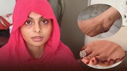 महिला को 6 महीने में जहरीले सांप ने 7 बार काटा... हर बार ICU से मौत को दी मात, अब डर के साए में पति