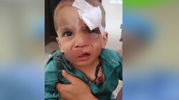 Rajasthan: उदयपुर में आवारा कुत्तों का आतंक, बच्चे के होंठ नोंचे, आंख जख्मी होते-होते बची