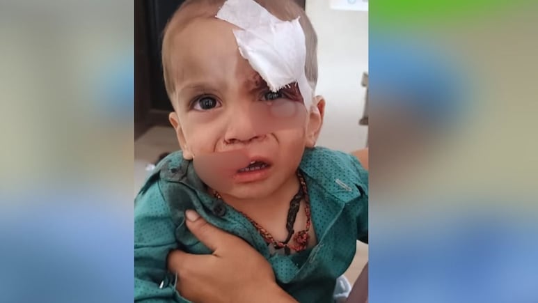 Rajasthan: उदयपुर में आवारा कुत्तों का आतंक, बच्चे के होंठ नोंचे, आंख जख्मी होते-होते बची