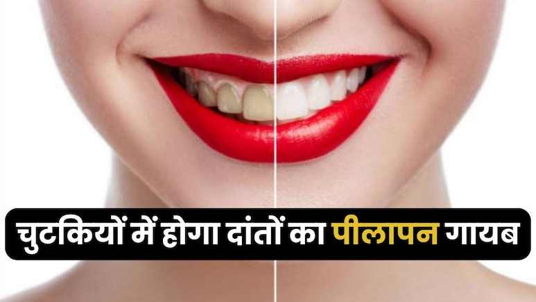 गंदे पीले दांतों को मोती सा चमका देंगी रसोई की ये चीजें, देखने के बाद नहीं होगा खुद की ही आंखों पर यकीन
