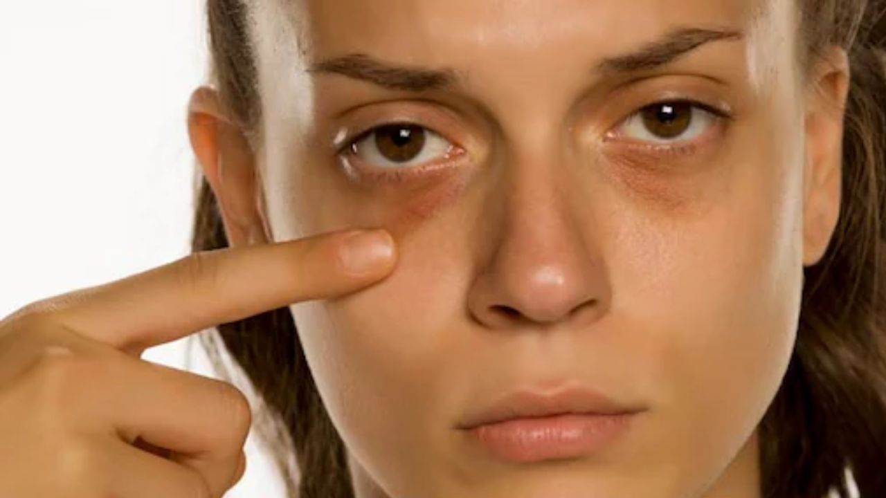 Dark circle हटाने का आसान घरेलू नुस्खा, खाने की ये 2 चीजें आंखों के काले घेरे कर सकती हैं चुटकियों में हल्का