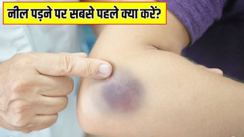 चोट के बाद नील पड़ जाए तो क्या करें? डायटीशियन ने बताया कैसे जल्दी हटेंगे निशान