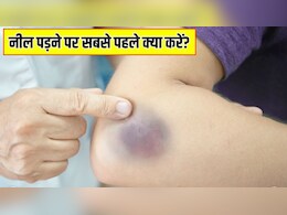 चोट के बाद नील पड़ जाए तो क्या करें? डायटीशियन ने बताया कैसे जल्दी हटेंगे निशान चोट के बाद नील पड़ जाए तो क्या करें? डायटीशियन ने बताया कैसे जल्दी हटेंगे निशान