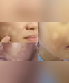 चेहरे पर सफेद धब्बे को कैसे हटाएं? स्किन की डॉक्टर ने बताया कैल्शियम की कमी नहीं ये है असली कारण