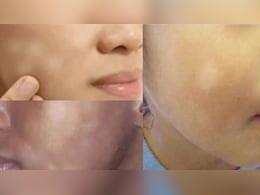चेहरे पर सफेद धब्बे को कैसे हटाएं? स्किन की डॉक्टर ने बताया कैल्शियम की कमी नहीं ये है असली कारण चेहरे पर सफेद धब्बे को कैसे हटाएं? स्किन की डॉक्टर ने बताया कैल्शियम की कमी नहीं ये है असली कारण