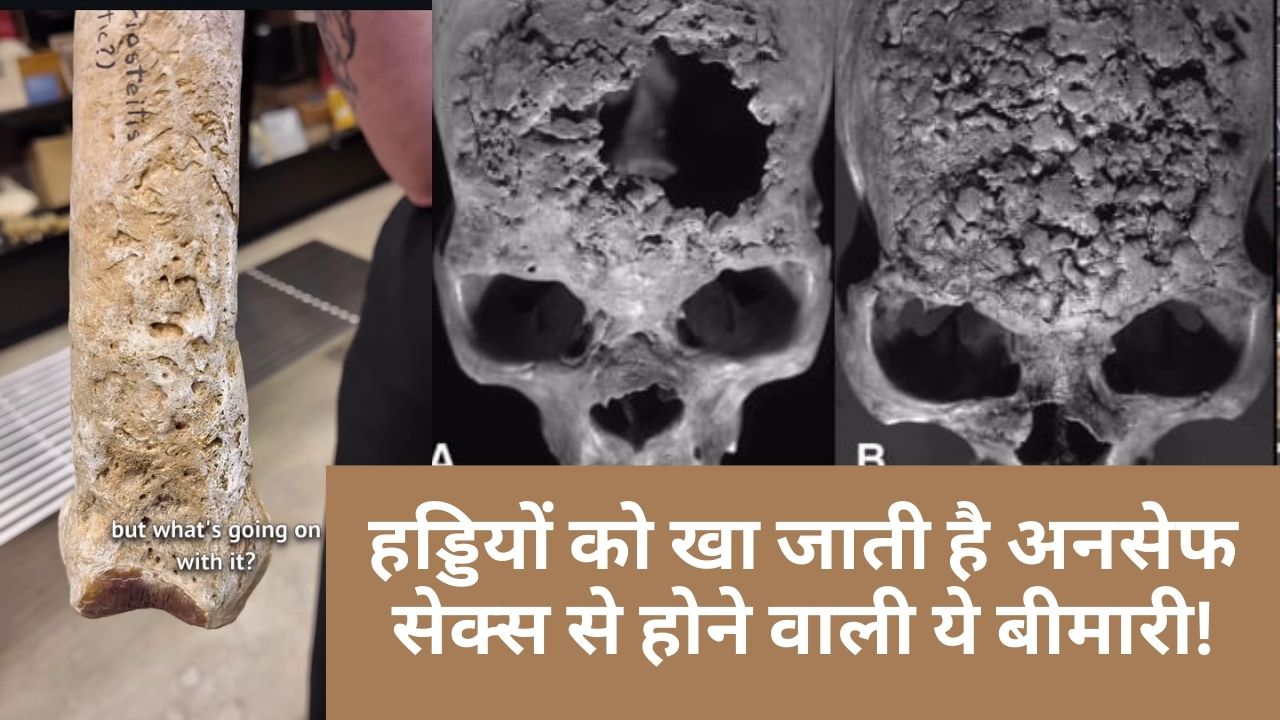 अनसेफ सेक्‍स से होने वाली एक बीमारी, जो हड्डियों को गला देती है, बन सकती है मौत की वजह