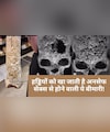 अनसेफ सेक्‍स से होने वाली एक बीमारी, जो हड्डियों को गला देती है, बन सकती है मौत की वजह