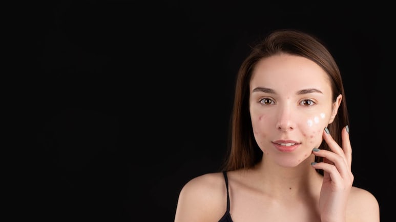 Acne Flare-Ups High During Festive Season? Skin Specialist Explains Why, Shares Tips Acne Flare-Ups High During Festive Season? Skin Specialist Explains Why, Shares Tips