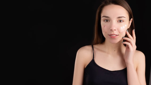 Acne Flare-Ups High During Festive Season? Skin Specialist Explains Why, Shares Tips