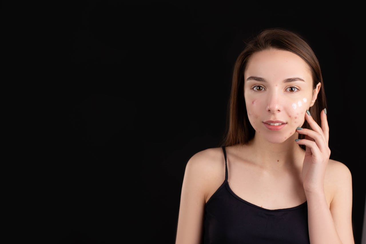 Acne Flare-Ups High During Festive Season? Skin Specialist Explains Why, Shares Tips