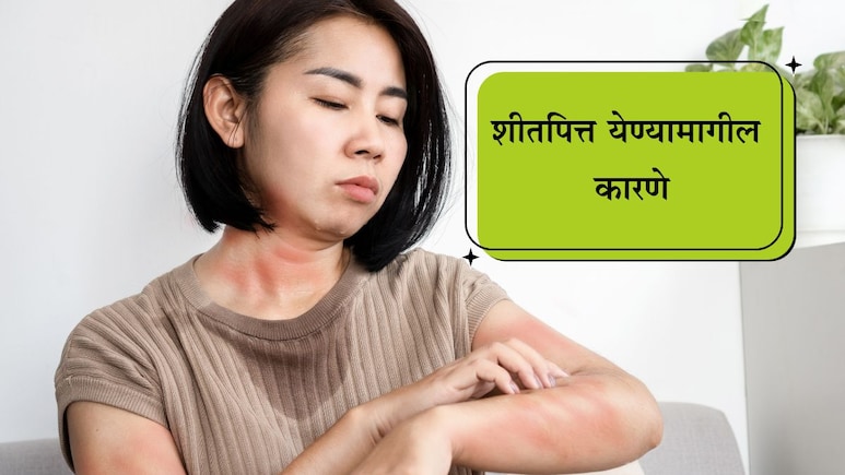 Hives Remedy: शरीरावर शीतपित्त आल्यास काय करावे? समस्येमागील ही आहेत मुख्य कारणं