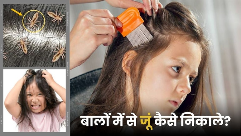 बिना किसी महंगी दवाइयों के बच्चों के सिर की जुएं होंगी गायब, जुओं का सफाया करने के लिए आजमाएं ये तरीका