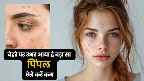 ये लगाते ही 5 मिनट में बैठ जाएंगे बड़े से बड़े गांठ वाले पिंपल्स, सूजन भी कर देगा कम