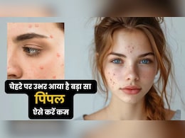 ये लगाते ही 5 मिनट में बैठ जाएंगे बड़े से बड़े गांठ वाले पिंपल्स, सूजन भी कर देगा कम ये लगाते ही 5 मिनट में बैठ जाएंगे बड़े से बड़े गांठ वाले पिंपल्स, सूजन भी कर देगा कम