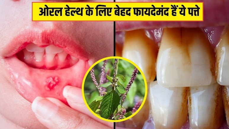 मुंह के छालों को एक ही बार में ठीक कर सकते हैं ये पत्ते, आयुर्वेदिक डॉक्टर ने बताया दांतों का पीलापन भी हो जाएगा साफ, जानिए इस्तेमाल का तरीका मुंह के छालों को एक ही बार में ठीक कर सकते हैं ये पत्ते, आयुर्वेदिक डॉक्टर ने बताया दांतों का पीलापन भी हो जाएगा साफ, जानिए इस्तेमाल का तरीका