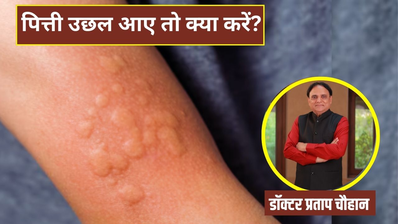 शरीर में पित्ती उछल आए तो क्या करना चाहिए?
